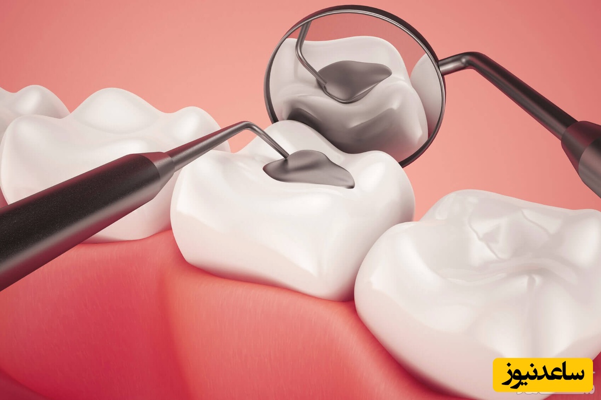 مراقبت از دندان های پر شده برای ماندگاری طولانی مواد داخل آن