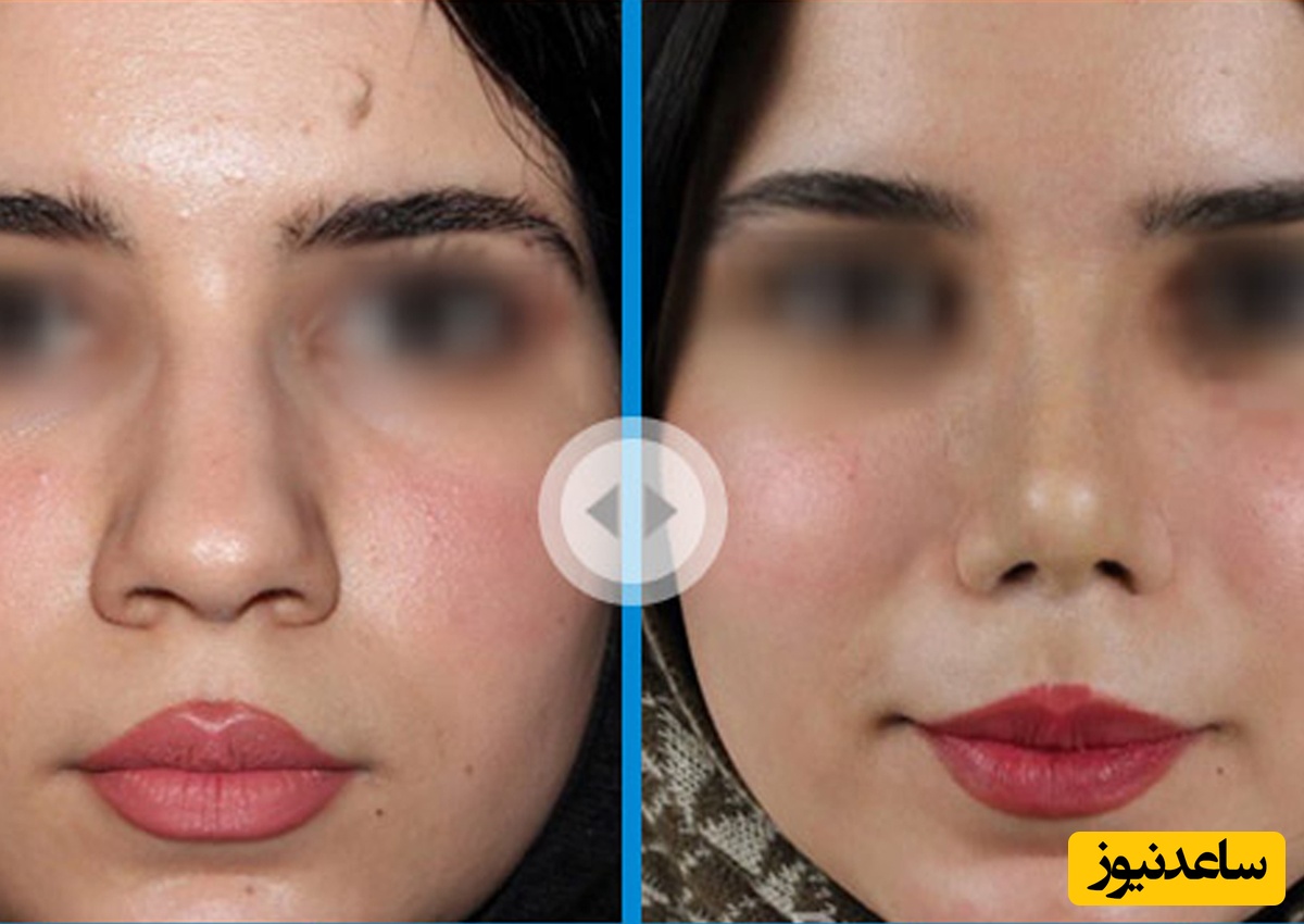 عمل بینی در تهران با پزشک 24 نمونه کار قبل و بعد