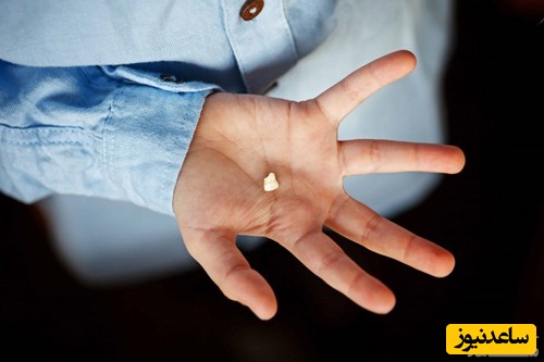 اقدامات اولیه برای دندان های بیرون آمده بر اثر ضربه