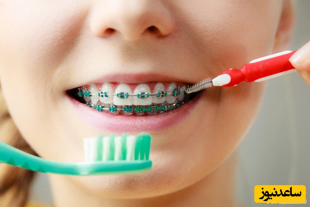 ویژگی‌های یک ریتینر خوب ارتودنسی چیست؟