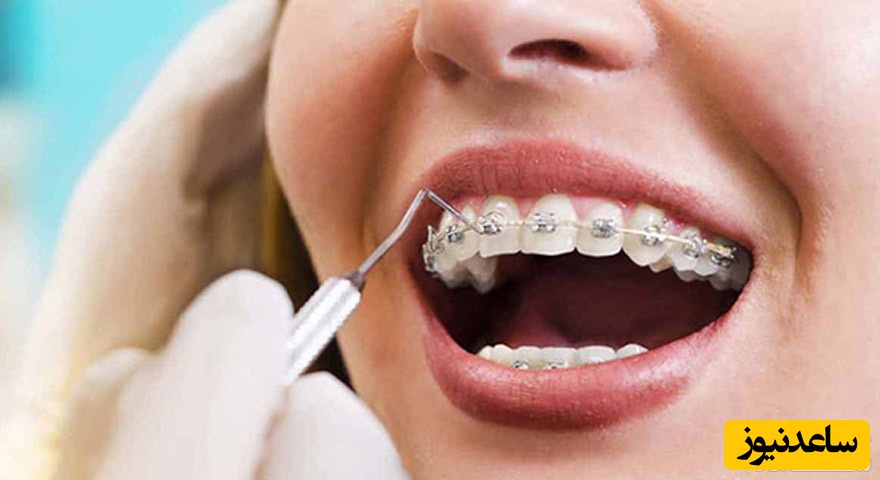 چند نوع براکت در ارتودنسی بکار میرود؟