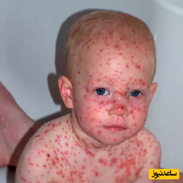 آبله مرغان (Chickenpox)