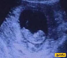 عکس سونوگرافی زنی که در شکمش شیطان زندگی می کند +عکس