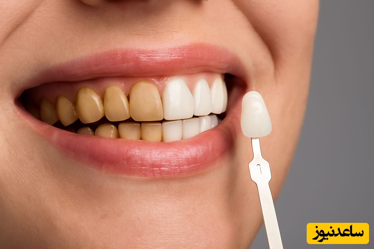 دلیل مهم برای زرد شدن دندان چیست؟