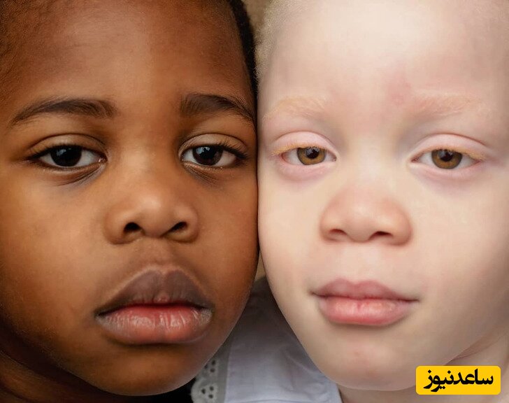 عجیب ترین زایمان دنیا؛ مادر نازایی بعد 10 سال تلاش یک دوقلوی سیاه و سفید پوست به دنیا آورد!+عکس