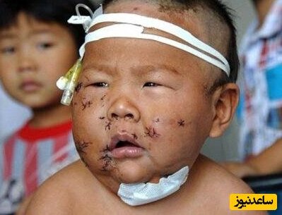 ضربات قیچی بر روی صورت کودک توسط مادرش