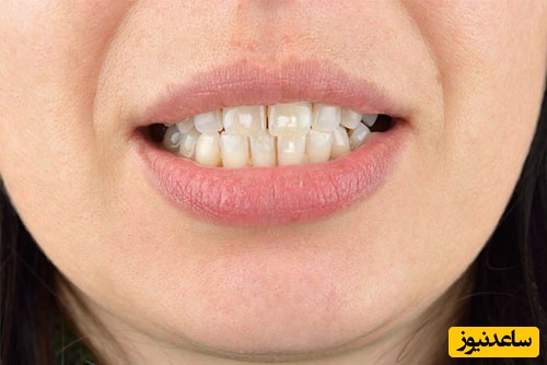 نکاتی برای پیشگیری از ابتلا به لکه های سفید دندانی