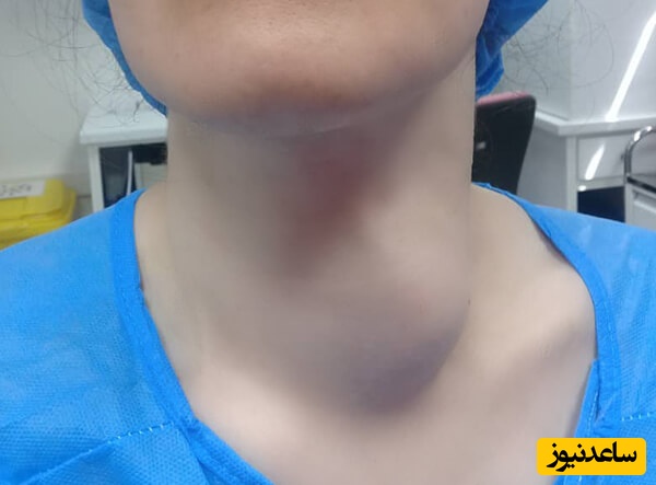 تورم غدد لنفاوی گردن