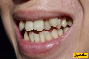 مشکل نامرتبی دندان‌ها در کودکان