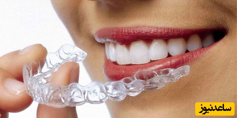 سوالات متداول درمورد ارتودنسی نامرئی