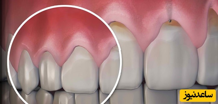 علت ها و دلایل تحلیل لثه