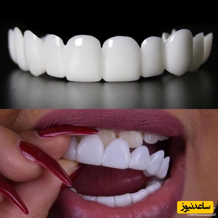 همه چیز در مورد لیفت (لمینیت) متحرک دندان