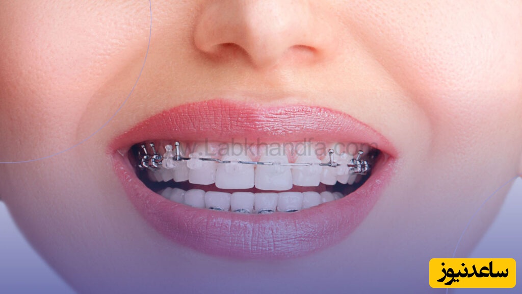 بهترین براکت ارتودنسی کدام است؟