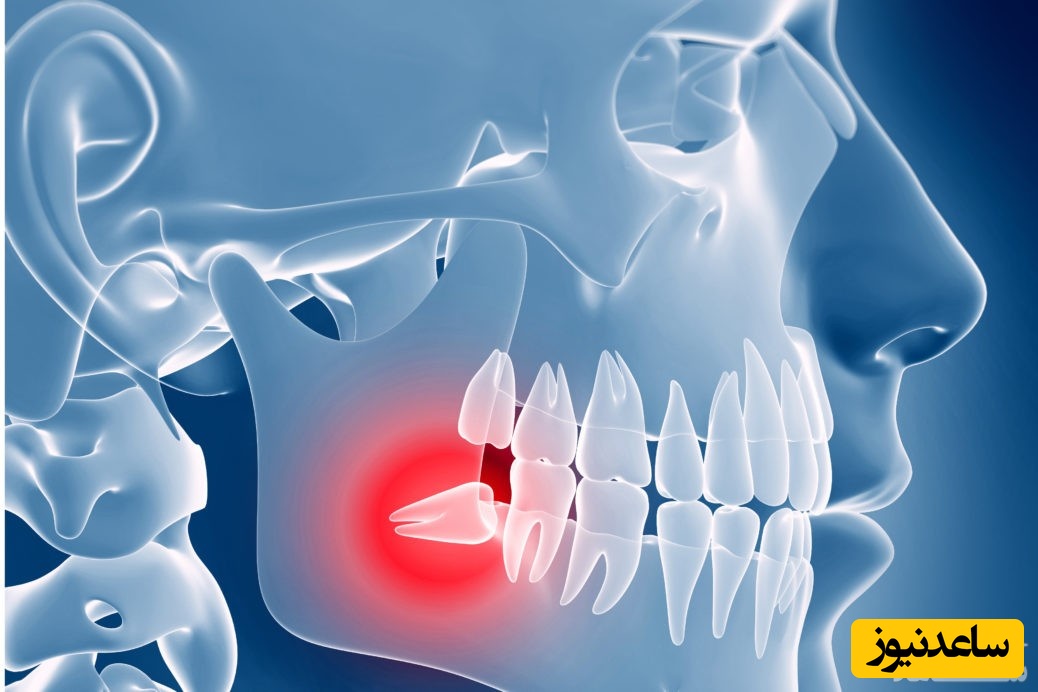 مراقبت های بعد از کشیدن و جراحی دندان عقل