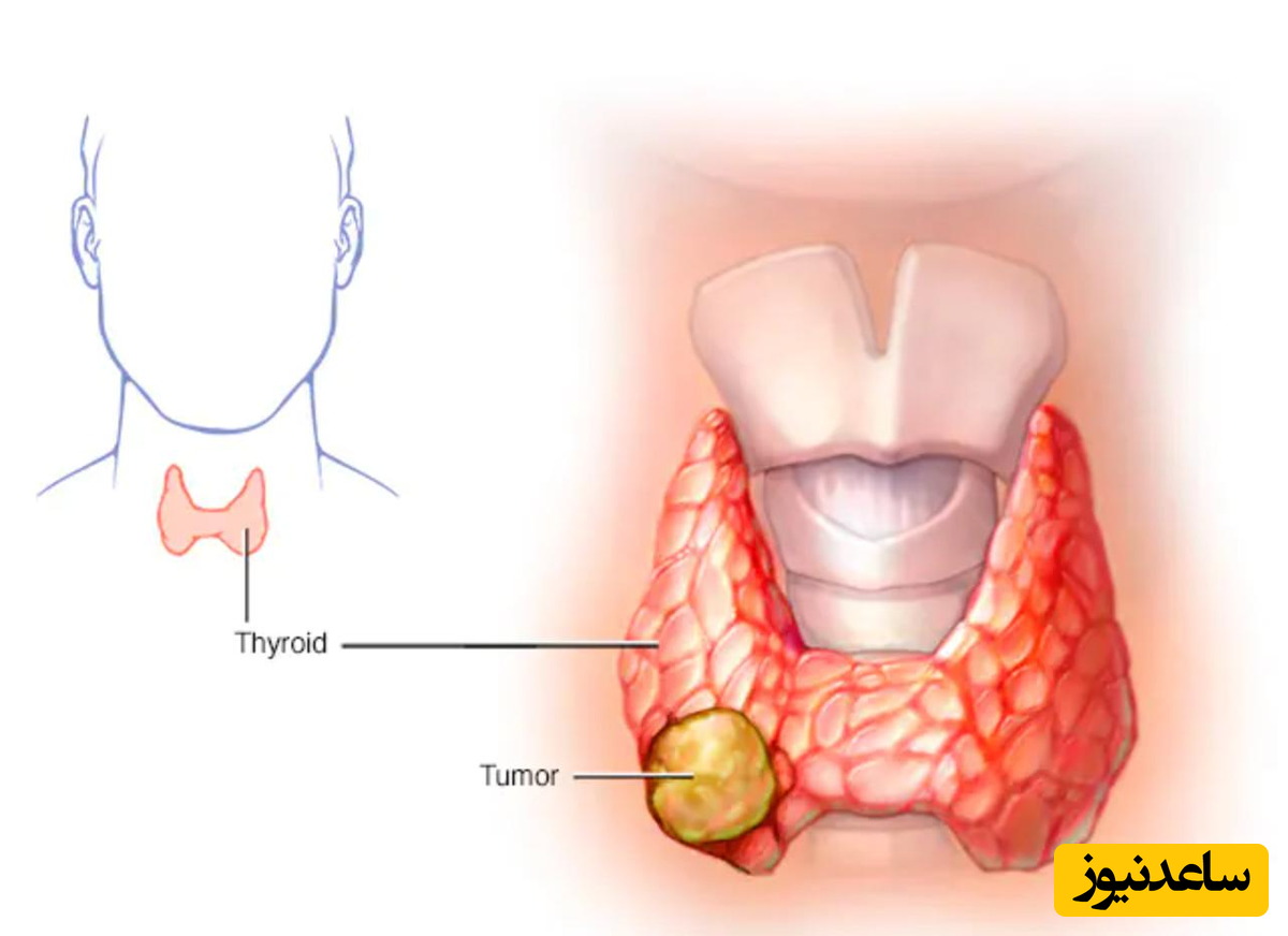 سرطان تیروئید چیست ؟ علائم و درمان آن