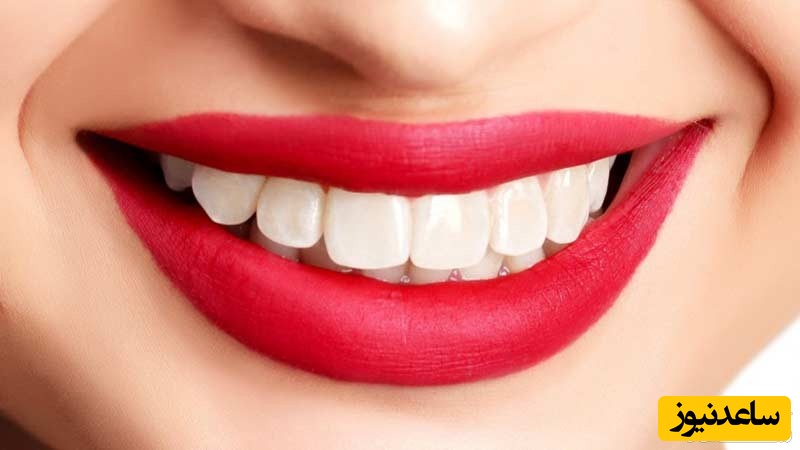 بلیچینگ دندان چیست؟