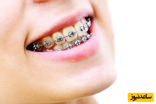 کش ارتودنسی و انواع آن