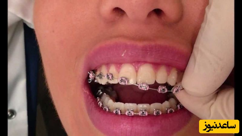 ارتودنسی بزرگسالان و کودکان چه شباهت ها و تفاوت هایی دارند؟