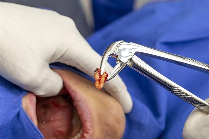 کشیدن دندان عقل خوب است یا بد ؟