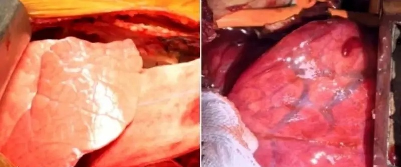 تصویری که ریه خوک را درست به هنگام پیوند و چهار روز بعد از پیوند نشان می‌دهد