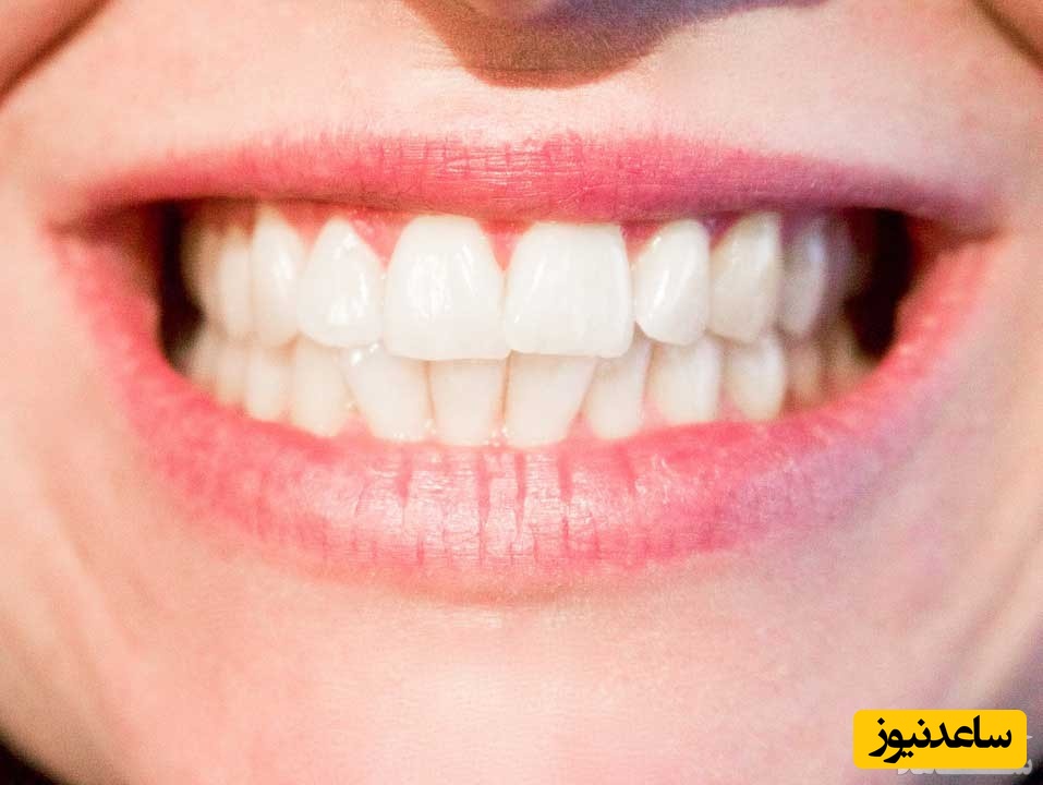 چرا لمینیت های سرامیکی تغییر رنگ می دهند؟