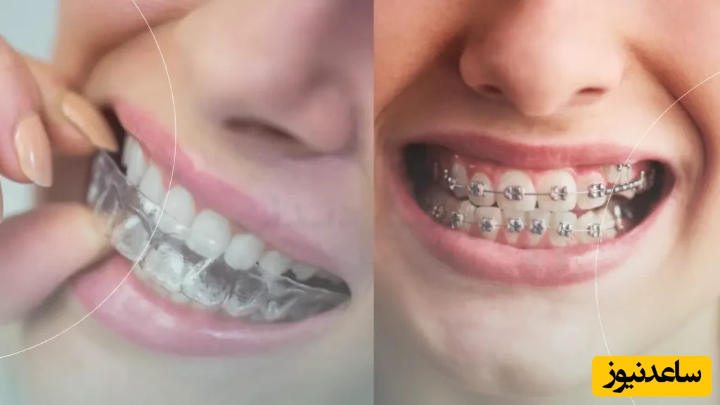 انواع کراس بایت دندان چیست؟