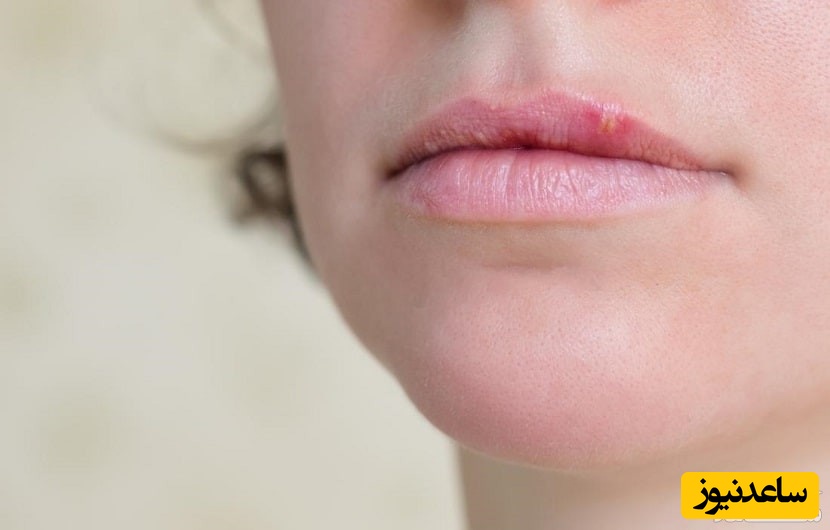 دلیل ایجاد تاول لب و درمان طبی و خانگی آن