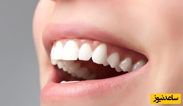 نحوه ی استفاده از جوش‌شیرین و هیدروژن‌ پروکسید برای سفیدی دندان ها