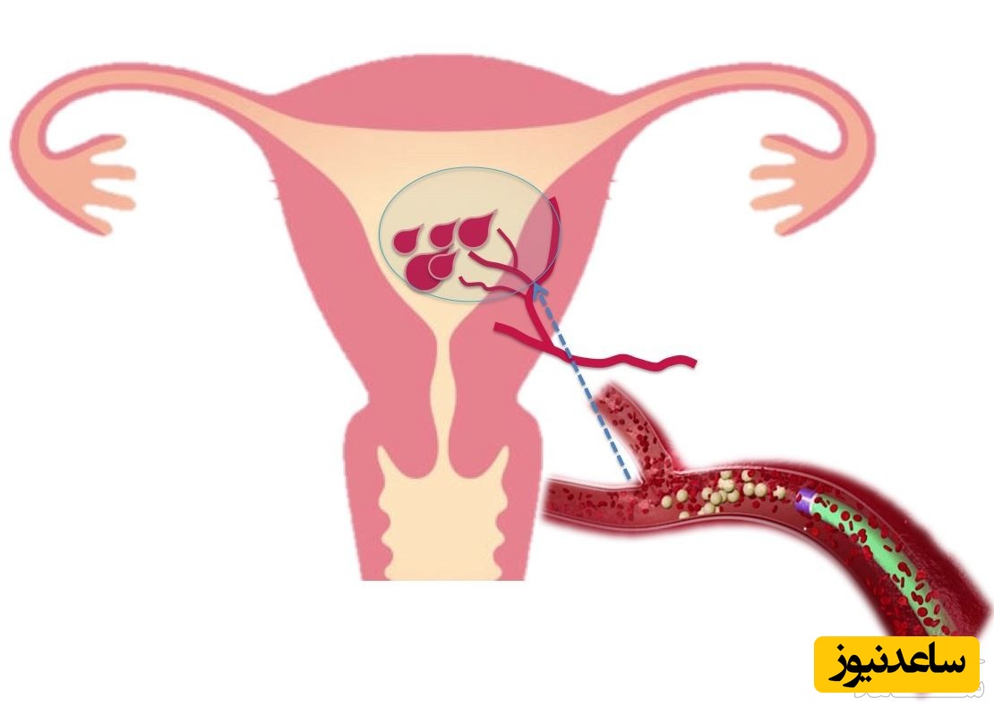 خانم‌ها شاید این مشکل شما باشد/ علل و علائم خونریزیهای غیرطبیعی رحم