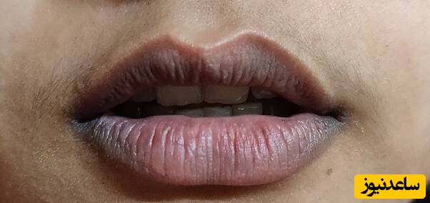 علت تیرگی پشت لب چیست و چه راه درمانی دارد؟