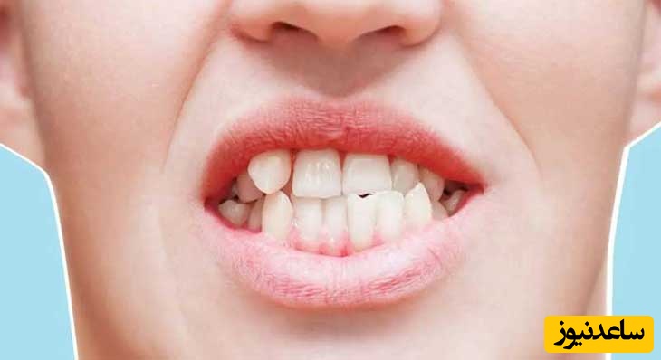 تجهیزات مورد استفاده در درمان کراس بایت چیست؟