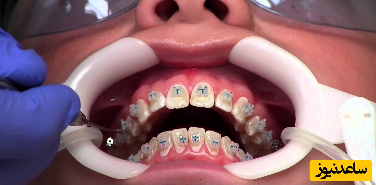 آیا براکت ارتودنسی دندان‌ها را لک می کند؟