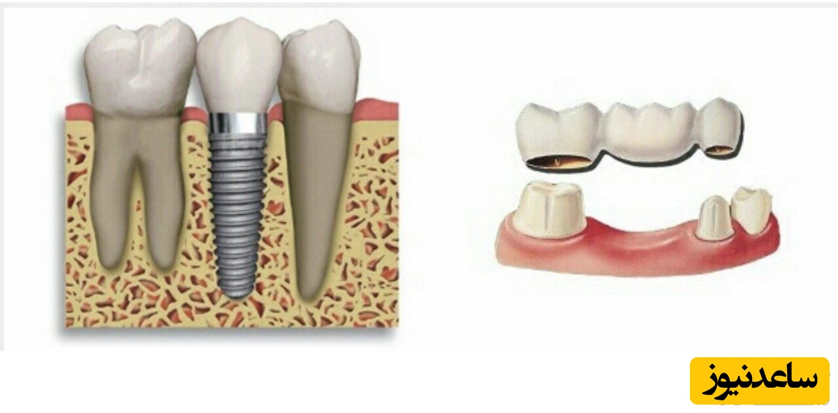 ایمپلنت یا بریج دندان کدام روش بهتر است؟