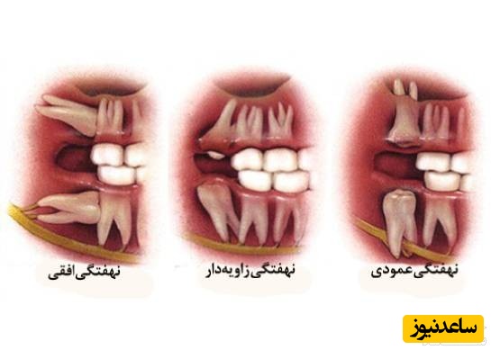 خطرات دندان نهفته
