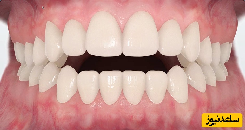 درمان اپن بایت چیست؟