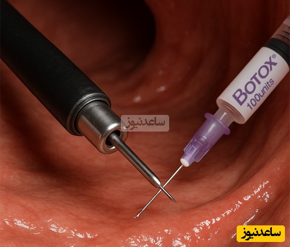 چرا بوتاکس معده در شهر تهران بسیار پرطرفدار شده؟