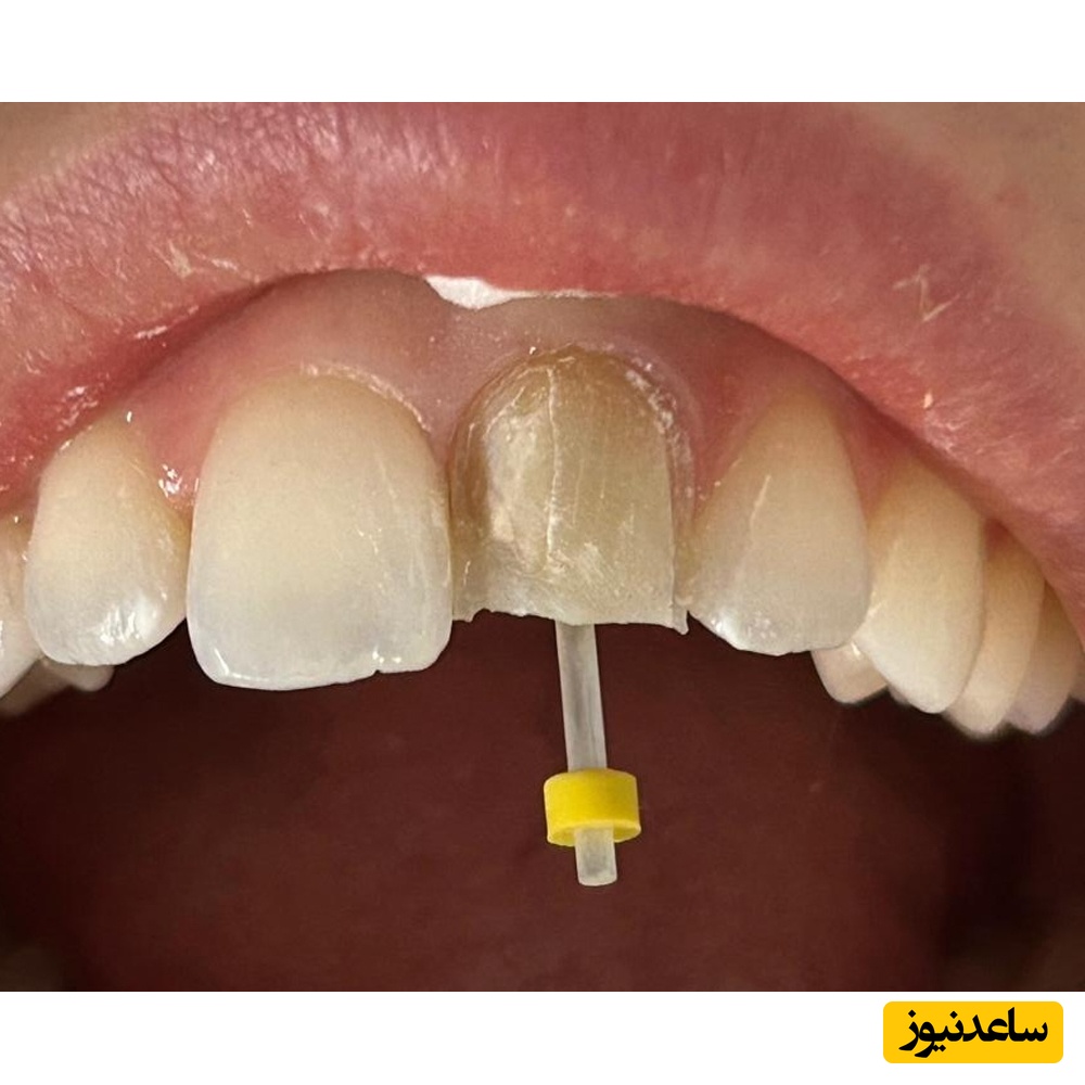 فایبر پست چیست؟