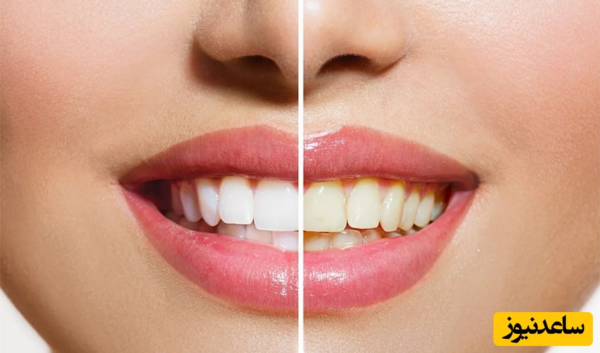 مزایا و معایب باندینگ دندان