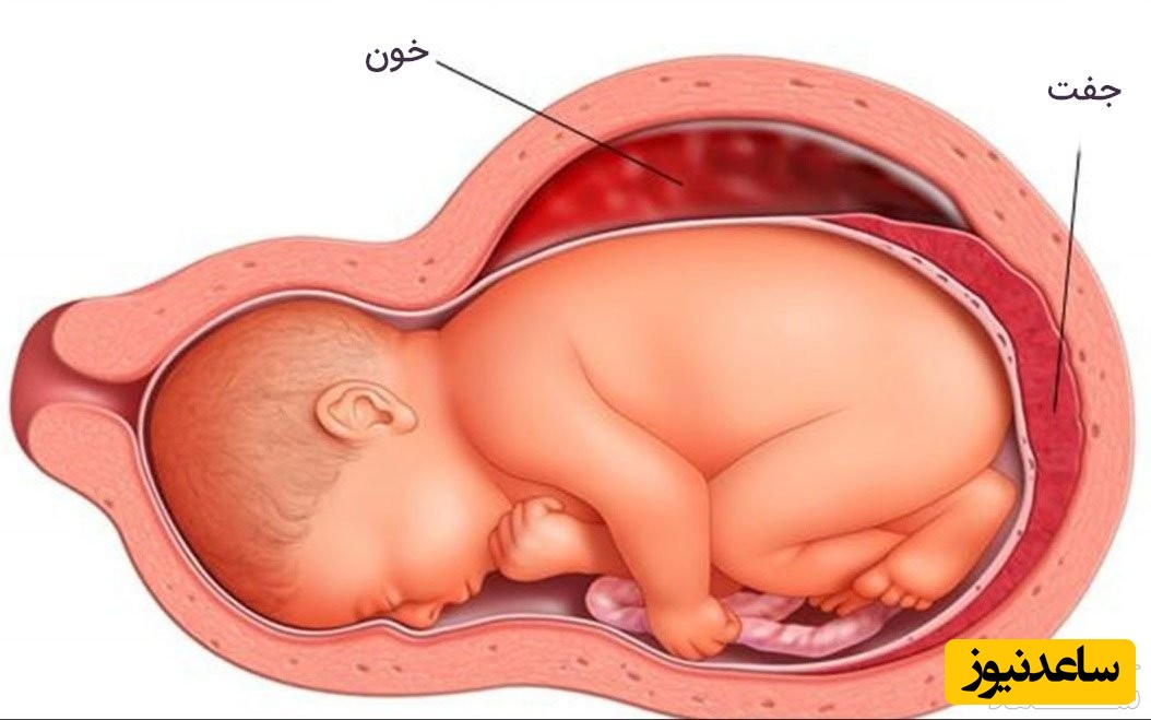 خطرات و عوارض هماتوم بارداری