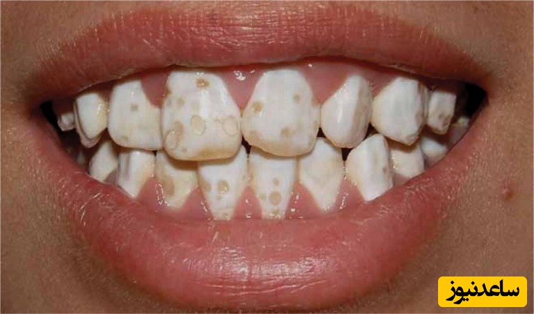 لکه های سفید روی دندان کودکان چگونه تشکیل می شوند؟