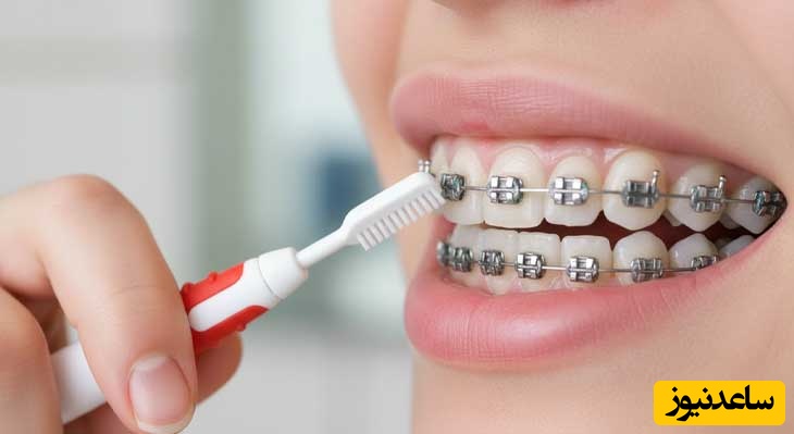 درمان  عفونت دندان در حین ارتودنسی