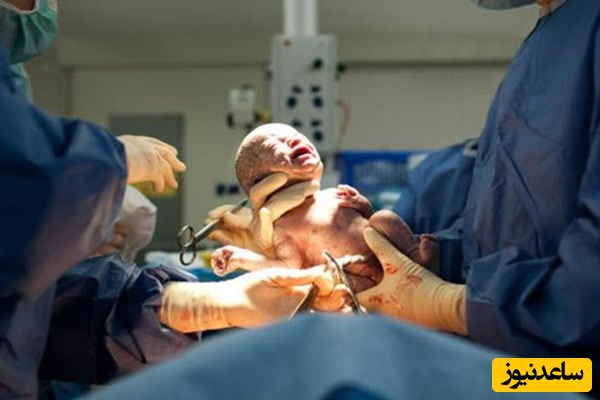 مزایا و معایب زایمان طبیعی با وکیوم