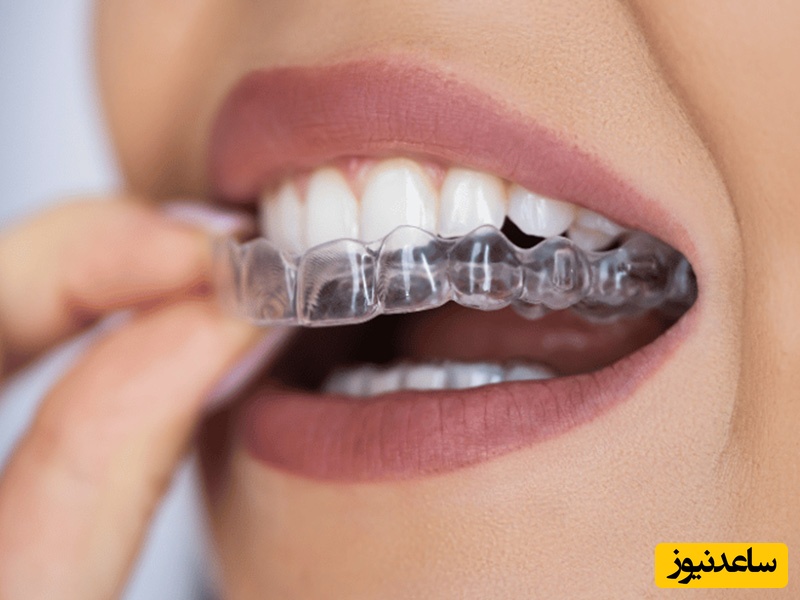 سوالات متداول درباره ی ارتودنسی نامرئی