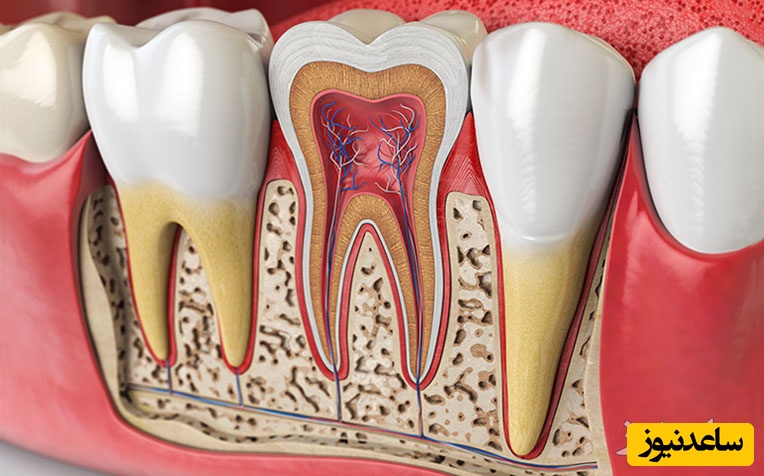 علائم پوسیدگی ریشه دندان