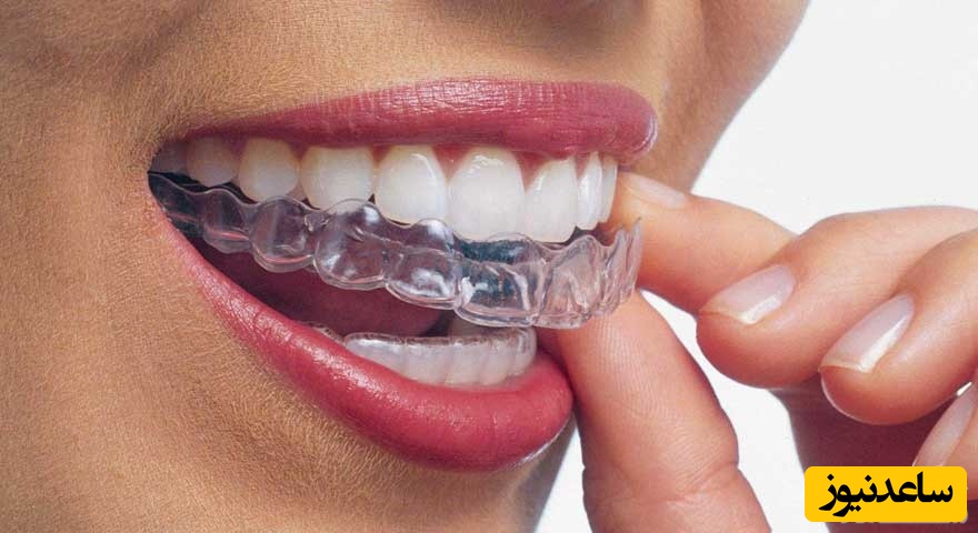 لق شدن دندان در اورتودنسی