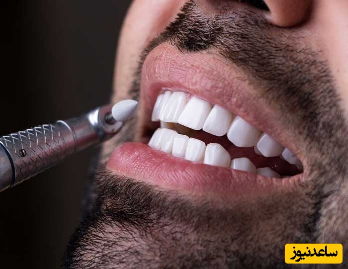 چگونه قهوه باعث تغییر رنگ لمینیت می شود؟