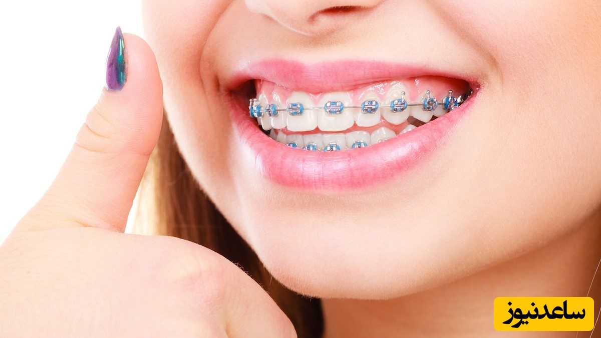 دوره ی ارتودنسی به مراقبت های بهداشتی بیشتری نیاز دارد!