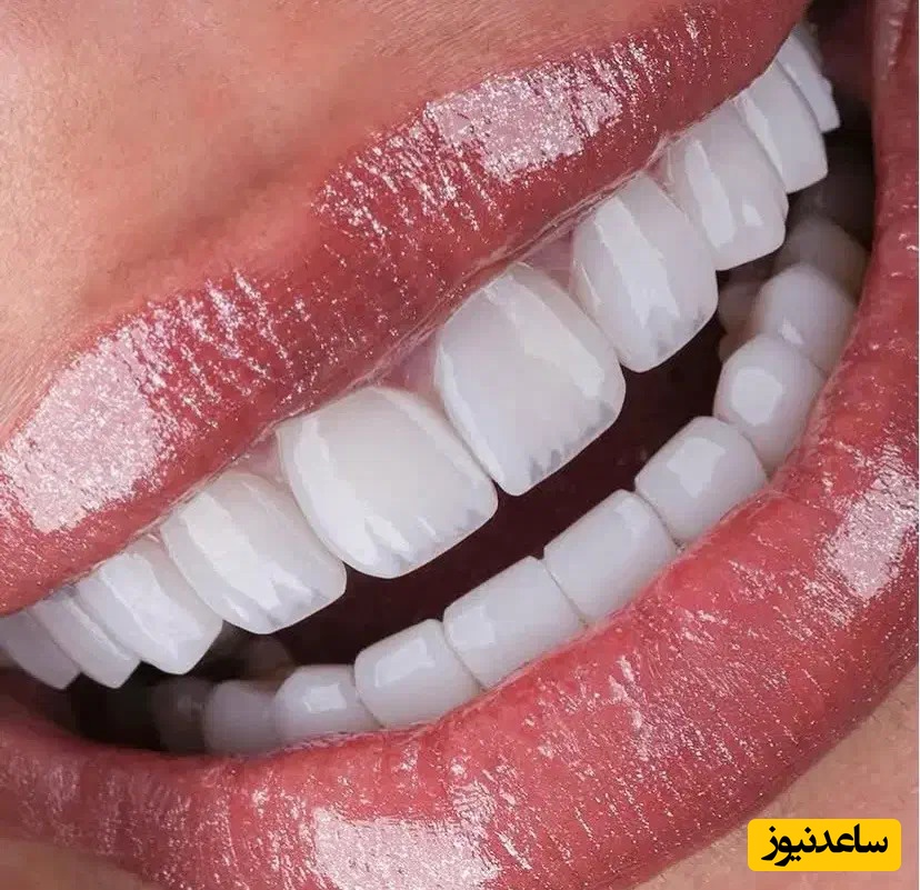 با انواع کامپوزیت دندان آشنا شوید