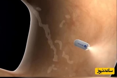 (ویدئو) خداحافظی با لوله آندوسکوپی؛ این کپسول هوشمند را ببلعید و تمام!