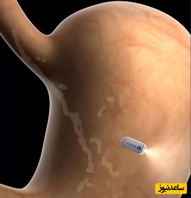 (ویدئو) خداحافظی با لوله آندوسکوپی؛ این کپسول هوشمند را ببلعید و تمام!